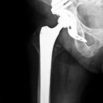 14788799 - postsurgical x-ray image shows an artificial hip joint